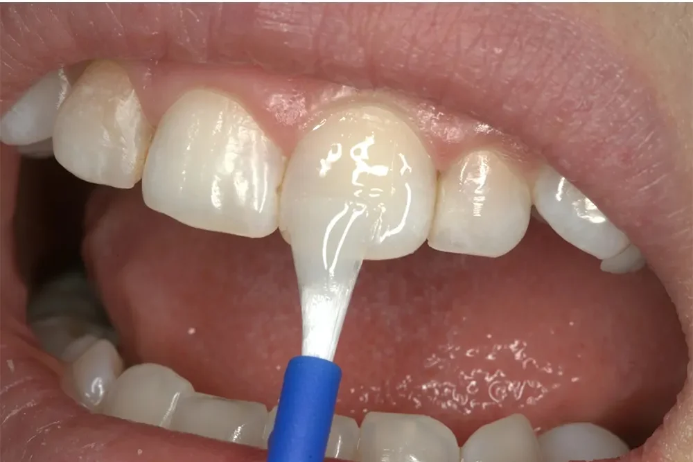 Get Fluoride Application for Kids treatment in Kothrud, Pune