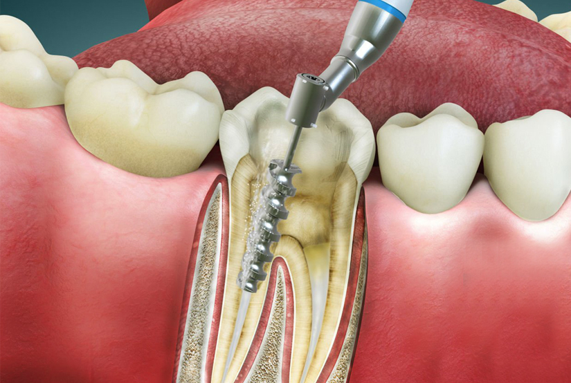 Get Single Sitting Root Canal Treatment in Kothrud