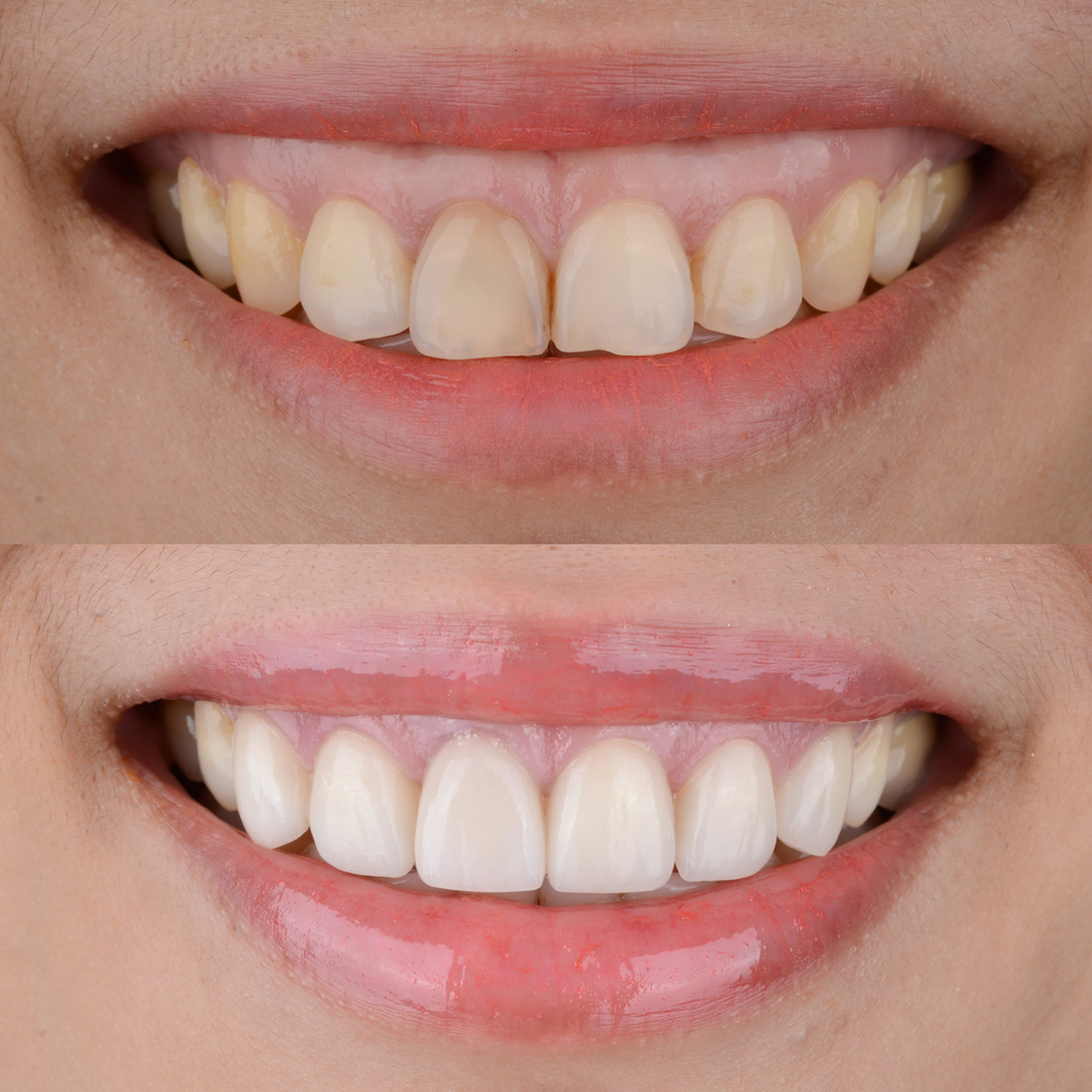 Get Cosmetic Dental Treatment in Kothrud , Pune