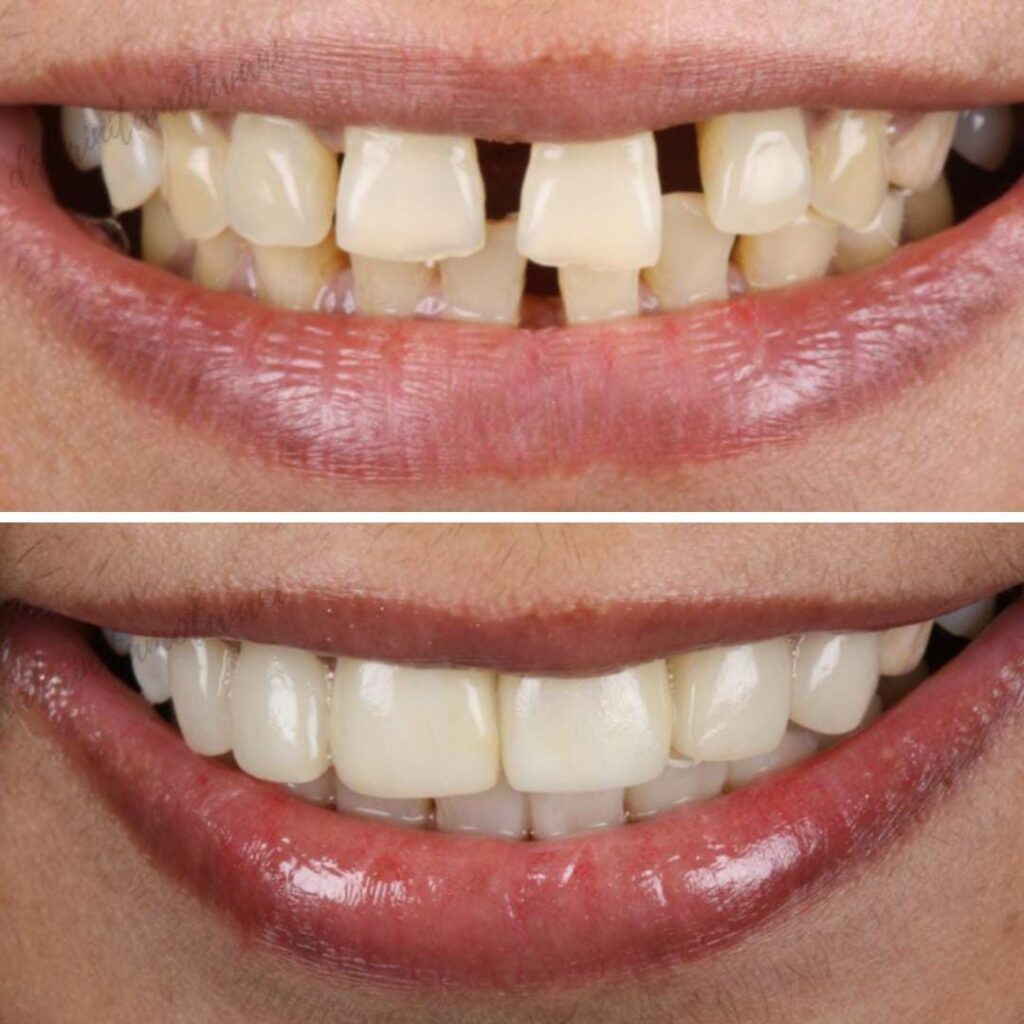 Get Diastema closure in Kothrud ,Pune