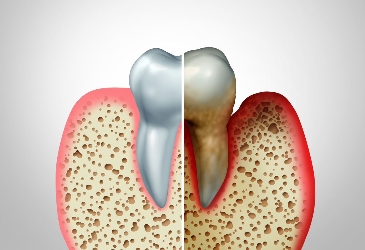 Fine Gum Disease Treatment In Kothrud