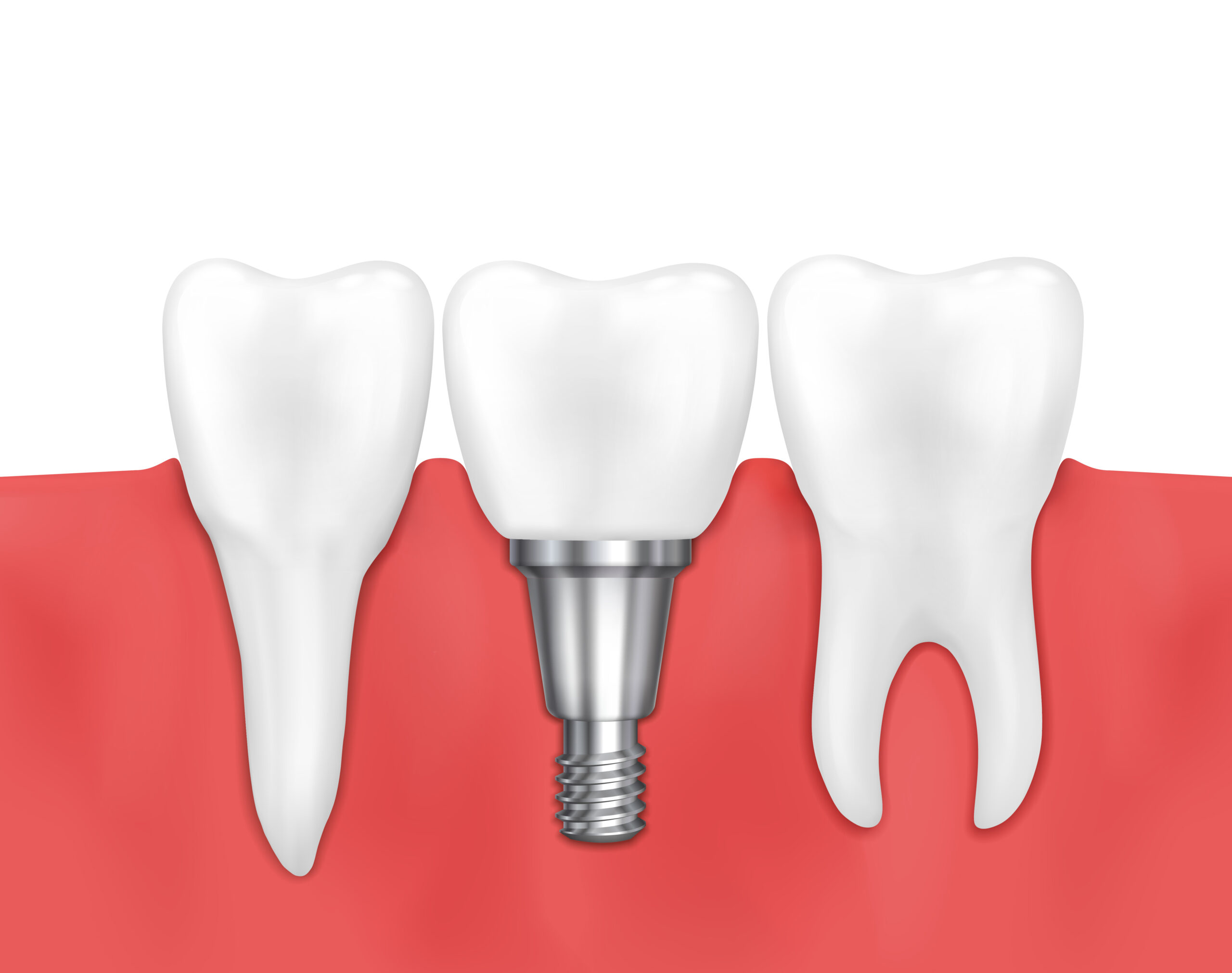Get Advanced implant procedure at Tooth & Co. Dental Clinic