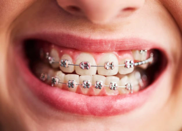 Find Braces Treatment in Kothrud,Pune