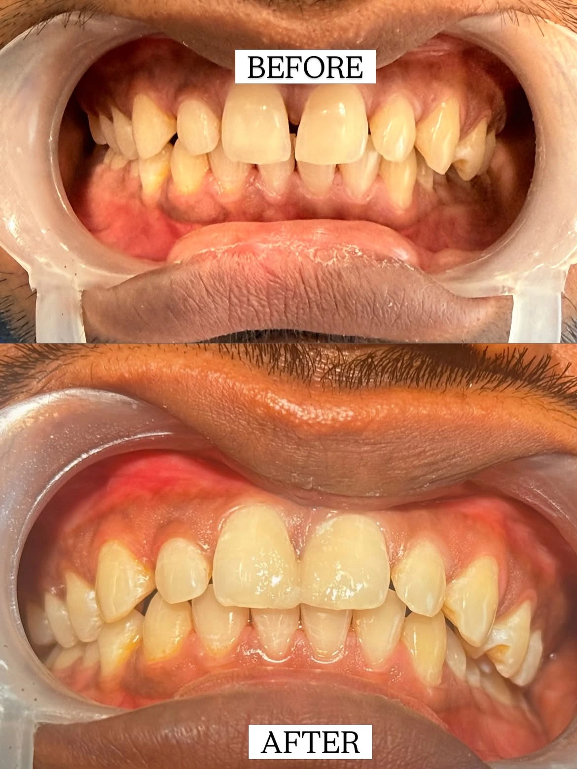 Dentist explaining teeth gap closure treatment options to patient in Kothrud clinic